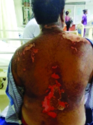 कोलड्रिंक फेक्ट्री में अमोनिया गैस की चपेट में आया मजदूर गंभीर रूप से झुलसा